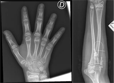 Sirolimus Restores Erythropoiesis and Controls Immune Dysregulation in a Child With Cartilage-Hair Hypoplasia: A Case Report